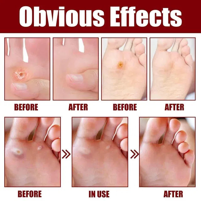 Corn & Callus Removal Serum (30ml) – Smooth Foot Care